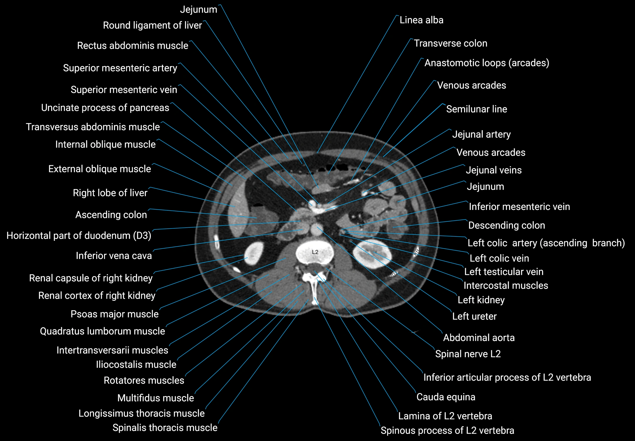 CT male pelvis axial cross sectional anatomy labelled radiology image -00079.webp
